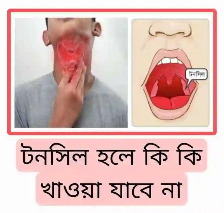 টনসিল হলে কি কি খাওয়া যাবে না [ঔষধের নামসহ বিস্তারিত]