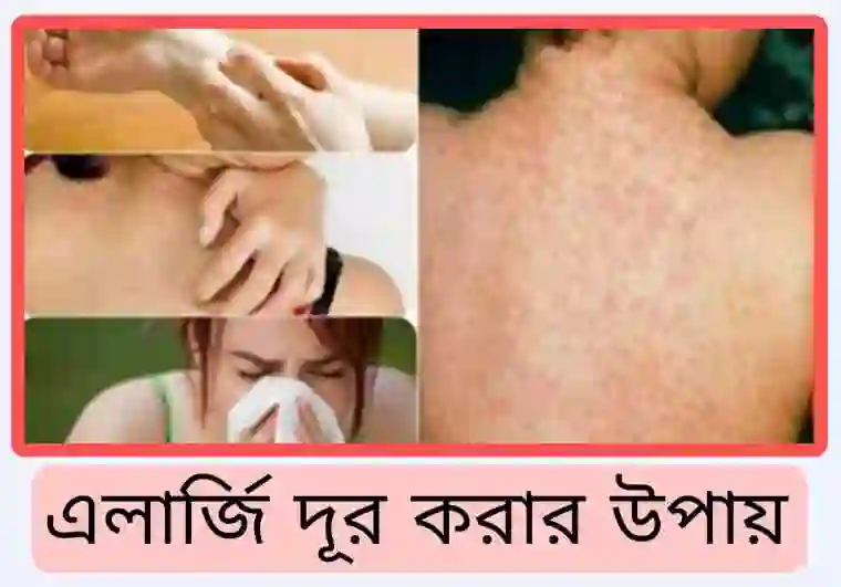 এলার্জি দূর করার উপায় [ঔষধসহ বিস্তারিত]