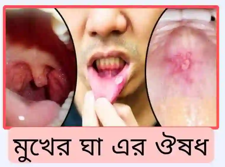 মুখের ঘা এর ঔষধ [জেল, ড্রপ ও ট্যাবলেট]