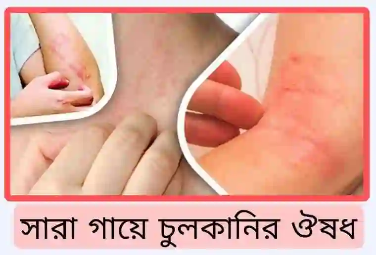 সারা গায়ে চুলকানির ঔষধ [নিয়ম ও দাম]