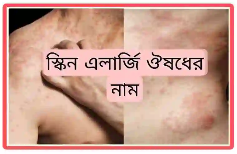 স্কিন এলার্জি ঔষধের নাম [১০০% কার্যকর ও দ্রুত ফলাফল]